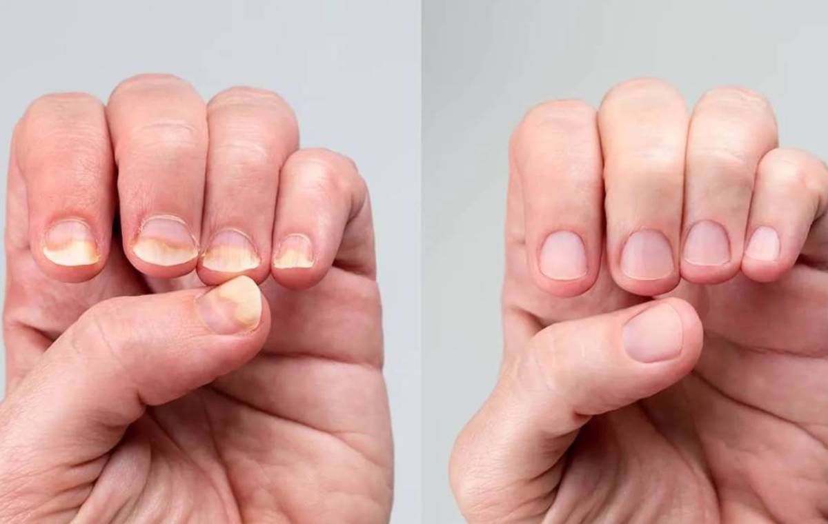 چه کسانی در معرض ابتلا به عفونت‌های قارچی هستند؟