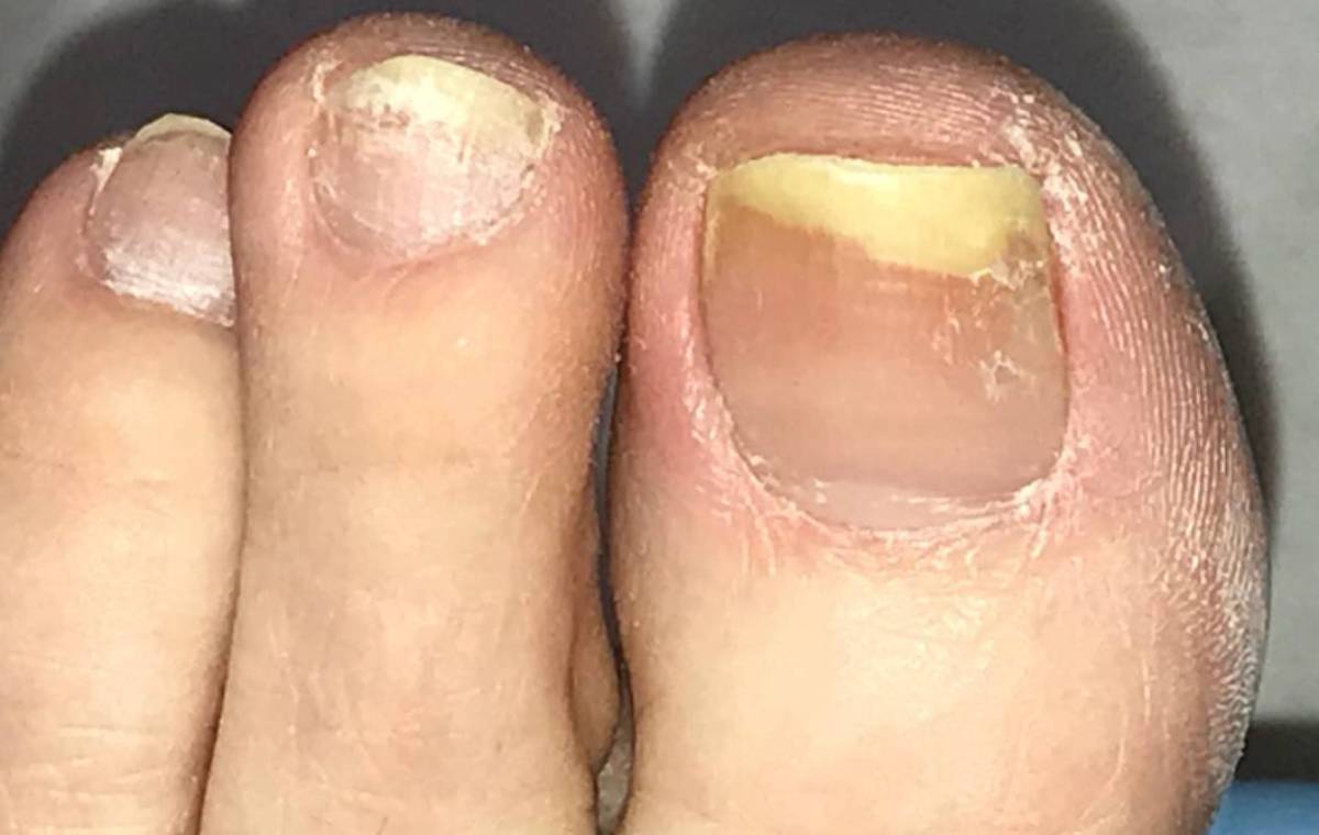 داروی قارچ ناخن پا و روش های درمان خانگی آن