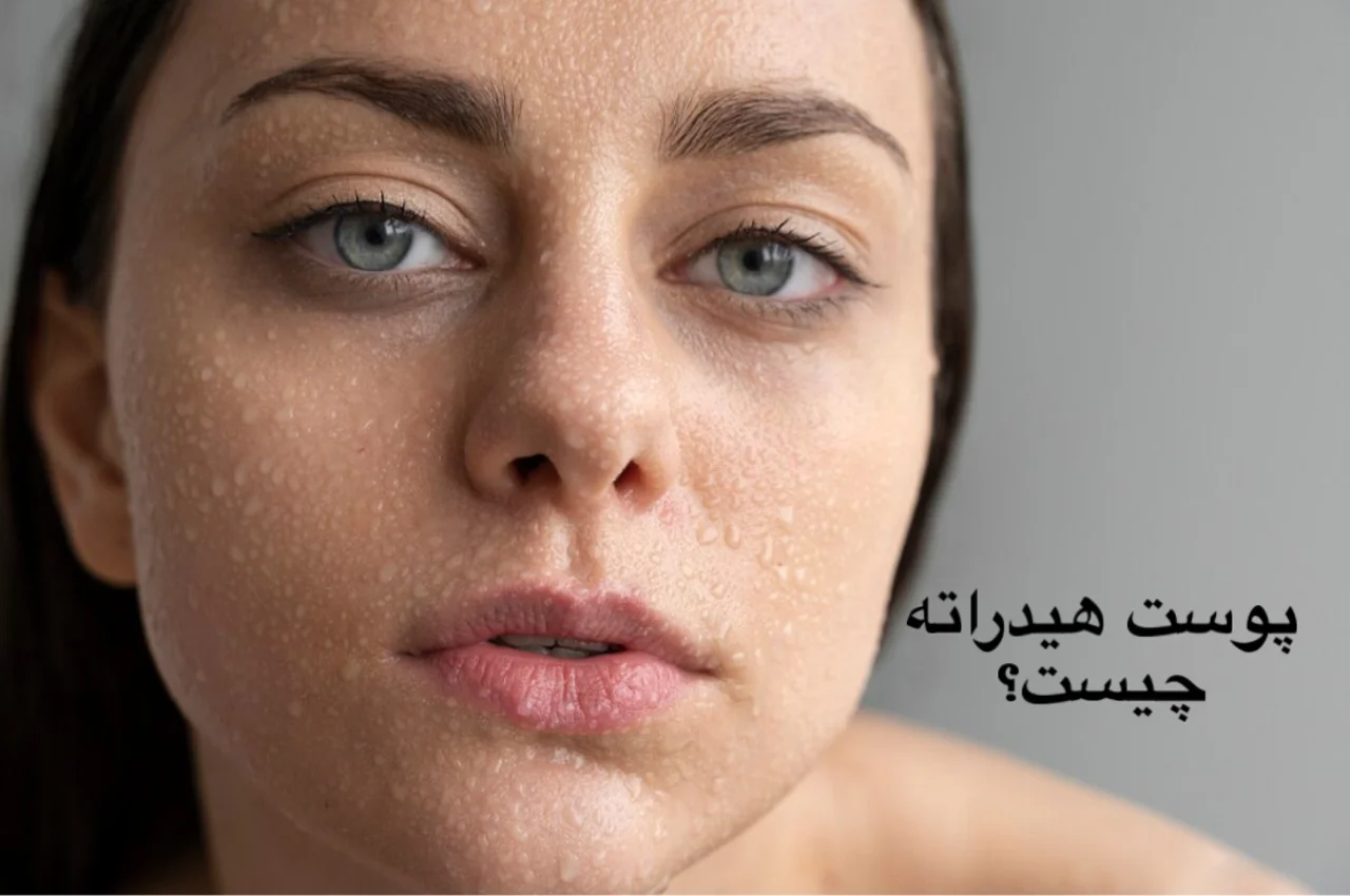 پوست دهیدراته چیست؟ | علائم، تفاوت با پوست خشک و بهترین روش درمان